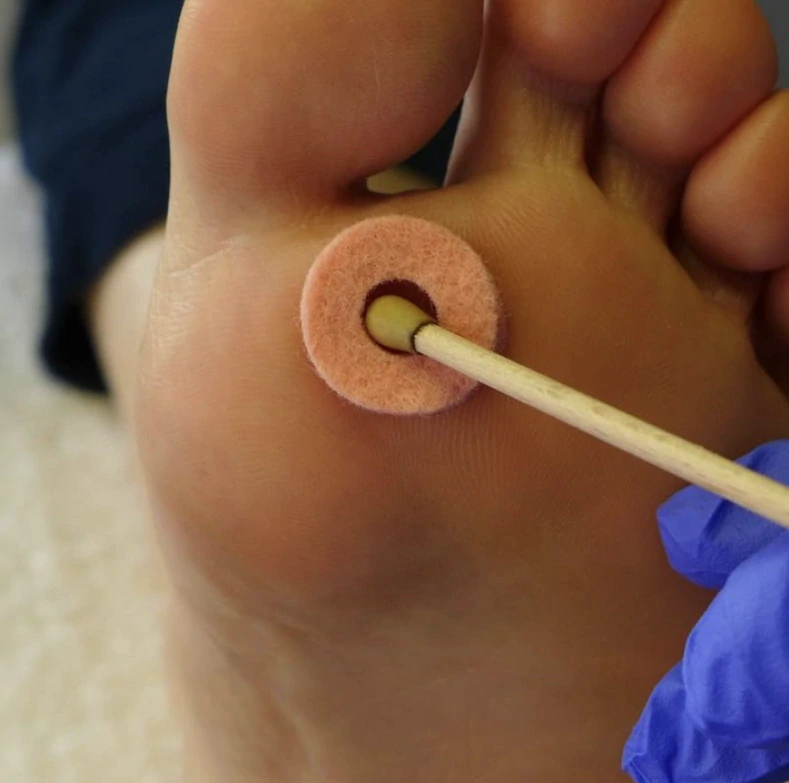 SILVERIN® STICKS, 75%, 10 ks