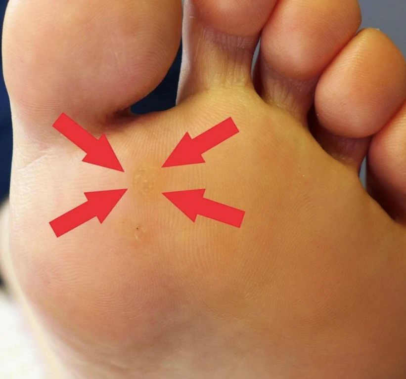 SILVERIN® STICKS, 75%, 10 ks